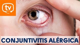 Claves sobre la conjuntivitis alérgica [upl. by Ariait]