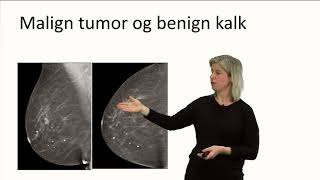 Klinisk mammografi  trippeldiagnostikk [upl. by Nauj]