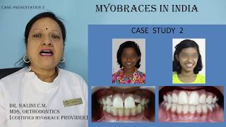 Myobrace case presentation 2 [upl. by Holli631]