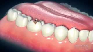 Dental Crowns Everything You Need to Know [upl. by Eul]