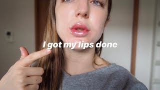 I got Lip Fillers in Japan Day by day recovery cost etc [upl. by Codding]