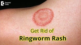 7 GREAT Tips for Prevention amp Treatment of RINGWORM RASH Dr Amrita Hongal Gejje  Doctors Circle [upl. by Nitsu892]