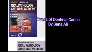 Zones of Dentinal Caries [upl. by Humberto82]