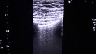 Pleural Sliding SignMP4 [upl. by Lanos]