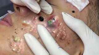 Big Cystic Acne Blackheads Extraction Blackheads amp Milia Whiteheads Removal Pimple Popping 11 [upl. by Nahoj]