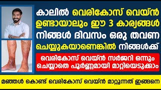 വെരികോസ് വെയ്ൻ സർജറി ചെയ്യാതെ പൂർണമായി മാറ്റാൻ മഞ്ഞൾ ഇങ്ങനെ ഉപയോഗിച്ചാൽ മതി vericose vein malayalam [upl. by Akenn814]