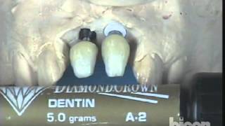 Integrated Abutment Crown™ IAC Lab Demonstration [upl. by Auhesoj]