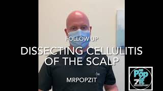 Follow up alert Dissecting Cellulitis of the scalp patient post 1 month on Accutane 95 improved [upl. by Assetal]