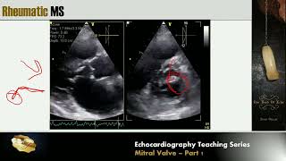 Lecture 11  Mitral Valve Part 1 [upl. by Aihsilef513]