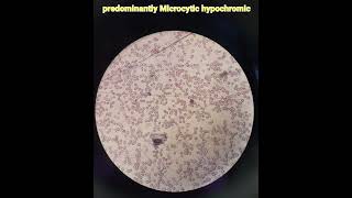 Hematologyanaemiamicrocytic hypochromicpathologymedical [upl. by Cesaro]