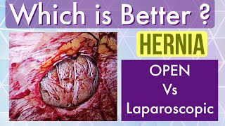 Hernia operation  OPEN vs LAPAROSCOPY [upl. by Alamap]