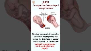 Antepartum hemorrhage in hindi  APH in pregnancy  cause of aph [upl. by Maril]