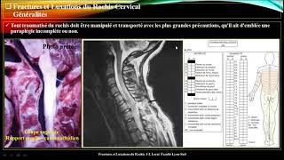 Traumatisme du rachis cervical 🤩 meilleure explication 🤩 par Pr Atia [upl. by Ggerk]