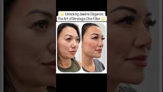 🌟 Unlocking Jawline Elegance The Art of Strategic Chin Filler 🌟 [upl. by Yug]