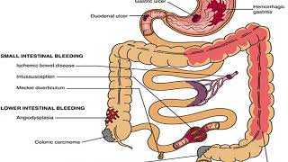 Gastrointestinal Bleeding  Tropical Medicine  5th grade  by Dr Adnan Ahmed [upl. by Lucien558]