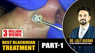 BEST BLACKHEAD TREATMENT PART 1 COMEDONE EXTRACTION NOSE [upl. by Caro]