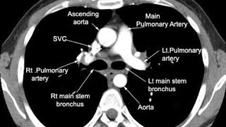 CT Scan Pulmonary Angio PTE protocol [upl. by Nioe]