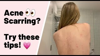 TRY THESE ACNE SCARRING TIPS😙HELP WITH SKIN PICKING SCARRING💕 [upl. by Nosneh287]