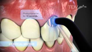 CERVICAL MATRIX TDV  Class V Restorations [upl. by Iturk]