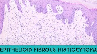 Epithelioid fibrous histiocytoma benign ALK1 skin tumor ALK gene fusion pathology dermpath [upl. by Lohse946]