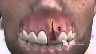 How to treat a dental Fistula [upl. by Valtin]