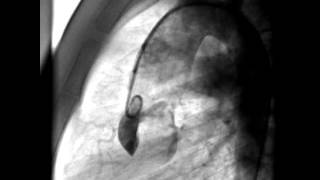 Aortopulmonary window  profiled in lateral aortogram [upl. by Bonny]