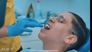 JE REFAIS MES DENTS EN TURQUIE AVEC EYUP ESTHETIQUE [upl. by Ertha]