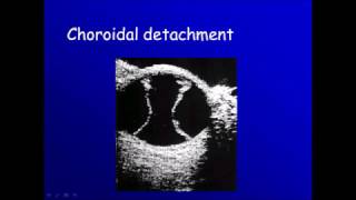 Ophthalmic ultrasonography 4 choroidal detachment [upl. by Armbruster]