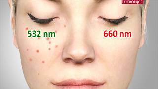 Freckles Pigmentation Treatment Singapore Ruvy Touch Pico Laser  Dr Justin Boey [upl. by Yart]