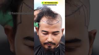 Best hair transplant result in low cost shorts hairtransplant [upl. by Ardnekal]