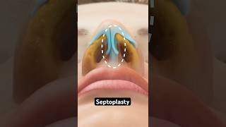 Septoplasty 3D Animation [upl. by Mages]