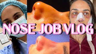 NOSE JOB VLOG emotional reveal rhinoplasty  Closet Raid [upl. by Darraj]