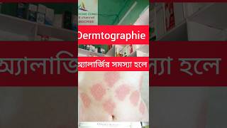 Allergy urticaria Dermtographie Bengali [upl. by Hutt]