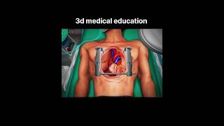 3d open heart surgery in best animation video [upl. by Melesa]