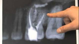 Endodontic Case  Found Calcium Hydroxide [upl. by Hebner]