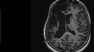 Post Stroke Gait and Postural Disturbances [upl. by Eiresed114]