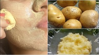 3 दिन Potato Face Pack  चेहरे की झाइयां दाग धब्बे व् कालापन हटाए  Skin Whitening Remedy [upl. by Curson]