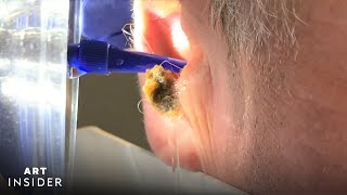 Water Device Painlessly Removes Earwax  Art Insider [upl. by Nortyad]