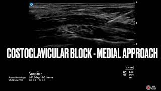 Costoclavicular block  medial approach  Regional anesthesia ultrasound regionalanesthesia [upl. by Nolek95]