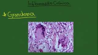 Inflamação Crônica  Resumo  Patologia Geral [upl. by Weisburgh706]