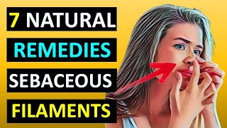 How to Get Rid of Sebaceous Filaments Naturally Using Home Remedies [upl. by Akcimehs537]