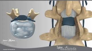 Lumbar Laminectomy and Fusion Presented by Swift Institute Reno Spine Surgeons and Spine Center [upl. by Knowland409]