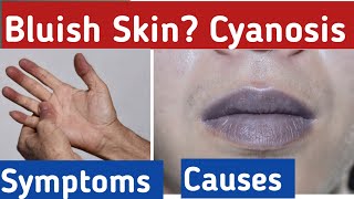 What is Cyanosis bluish skin cyanosis symptoms what is the cause of cyanosis [upl. by Nigel]