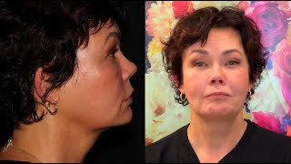 NONSURGICAL NECK LIFT WITH EMBRACERF [upl. by Ailemaj]