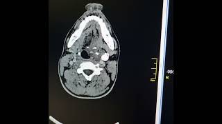 Cavernous hemangioma left side of neck [upl. by Sinylg]