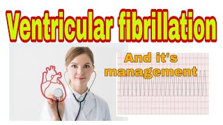 ventricular fibrillation  causes signs symptoms And management anaesthesiawithbabar2576 [upl. by Ranger353]