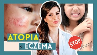 ✦ Piel ATÓPICA o eccema en BEBÉS y NIÑOS Cuidados y tratamiento del brote de dermatitis atópica [upl. by Alverta623]