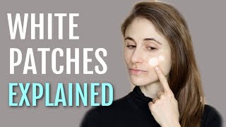 WHITE PATCHES ON THE FACE EXPLAINED PITYRIASIS ALBA DR DRAY [upl. by Idorb]