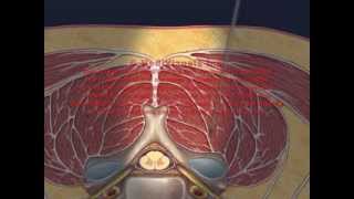 Cervical Interlaminar Epidural Injection Animation [upl. by Haras]