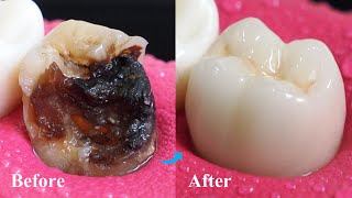 Incredible Restoration Of Tooth By Root Canal And Zirconia Crown [upl. by Retsam445]